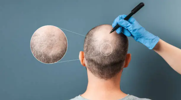 Understanding Hair Transplantation